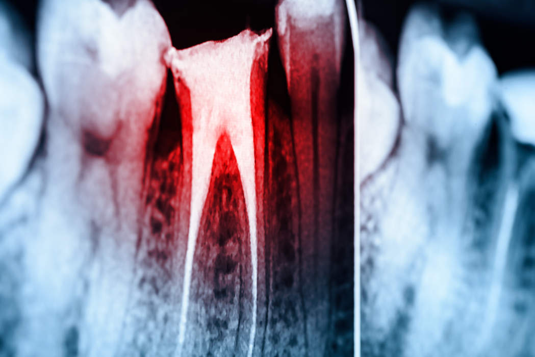 Root canal infection shown on X-ray