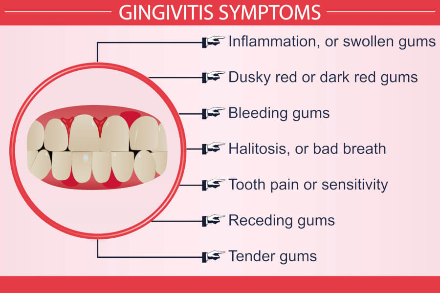 Gingivitis Superior Care For Both Prevention And Treatment